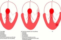 Breed QRS Complex Tachycardie, het zit  hem in de breedte?..
