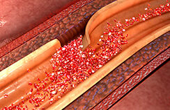 Duursport geeft  grotere kans op aortadilatatie