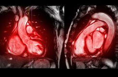 Hartritmestoornissen behandelbaar in MRI-scanner