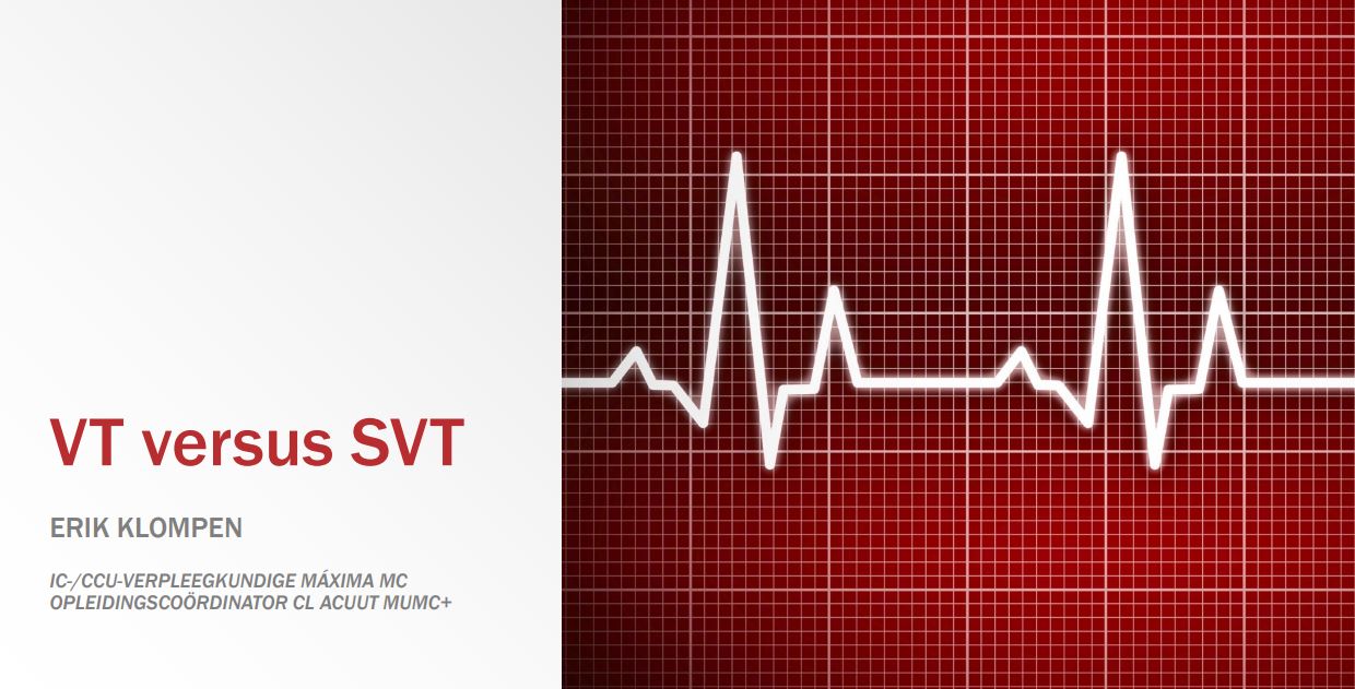 VT versus SVT