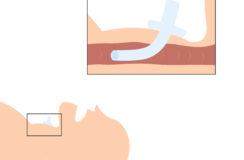 Above cuff vocalisation