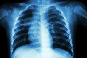 Artificial-Intelligence-beoordeelt-X-thorax.jpg